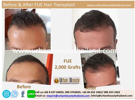 hair transplant bangkok price